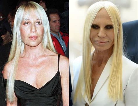 donatella versace anni|donatella versace before and after surgery.